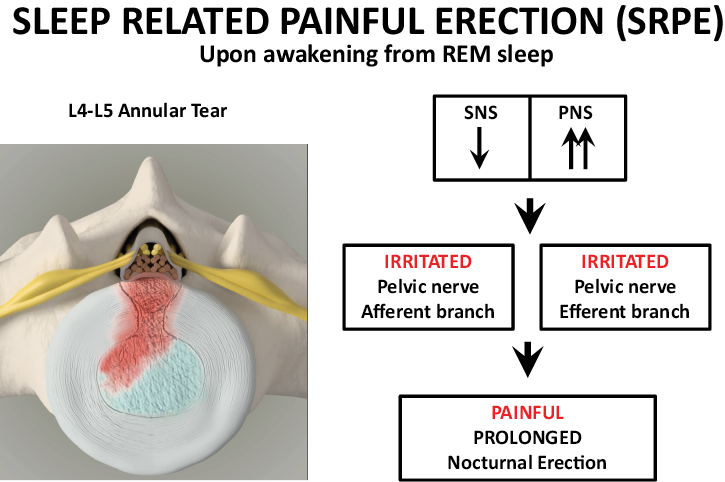 A Novel Hypothesis Explaining Sleep related Painful Erections